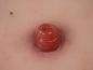 Preview: Erler Zimmer - Wundmoulage Ileostoma, inkl. Stativ
