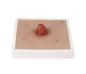 Preview: Erler Zimmer - Wundmoulage Ileostoma, inkl. Stativ