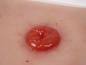 Preview: Erler Zimmer - Wundmoulage Kolostoma, inkl. Stativ