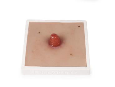 Erler Zimmer - Wundmoulage Ileostoma, inkl. Stativ