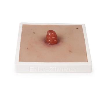 Erler Zimmer - Wundmoulage Ileostoma, inkl. Stativ
