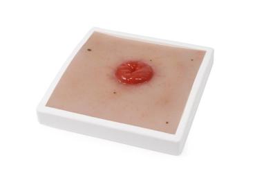 Erler Zimmer - Wundmoulage Kolostoma, inkl. Stativ