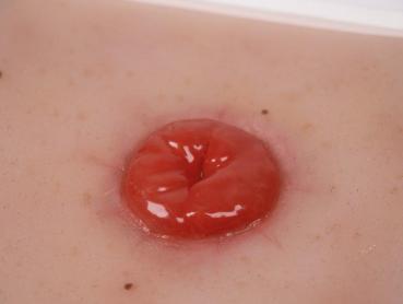 Erler Zimmer - Wundmoulage Kolostoma, inkl. Stativ