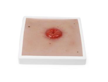 Erler Zimmer - Wundmoulage Kolostoma, inkl. Stativ