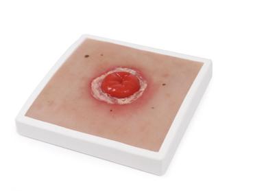 Erler Zimmer - Wundmoulage Kolostoma entzündet, inkl. Stativ