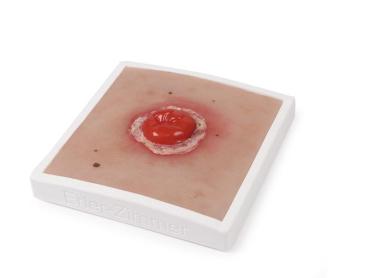 Erler Zimmer - Wundmoulage Kolostoma entzündet, inkl. Stativ