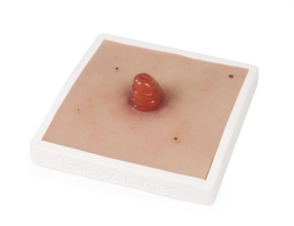 Erler Zimmer - Wundmoulage Ileostoma, inkl. Stativ