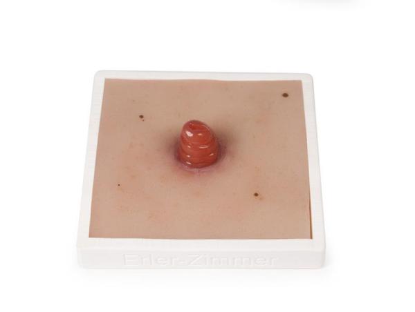 Erler Zimmer - Wundmoulage Ileostoma, inkl. Stativ