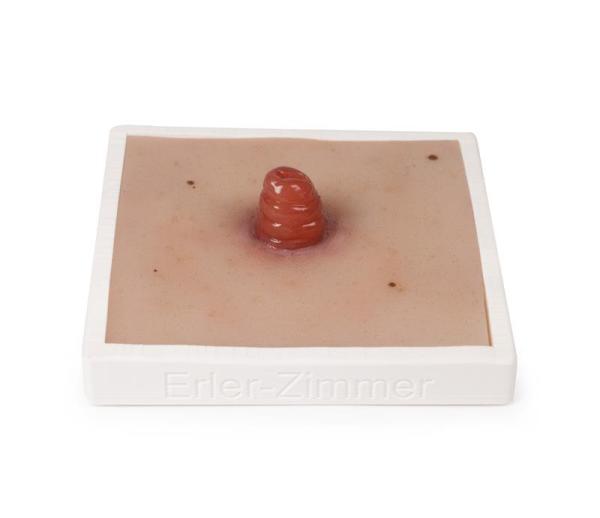 Erler Zimmer - Wundmoulage Ileostoma, inkl. Stativ