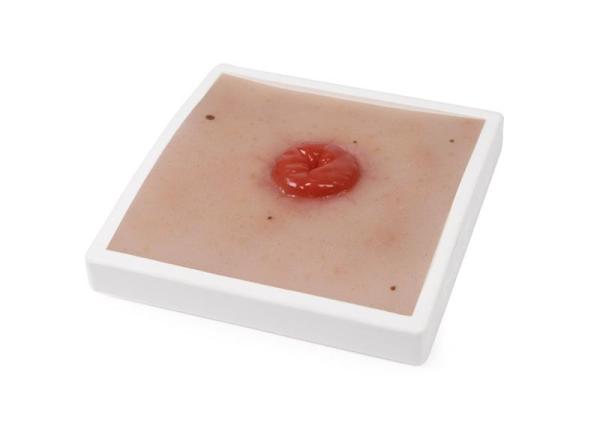 Erler Zimmer - Wundmoulage Kolostoma, inkl. Stativ
