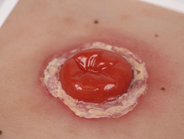 Erler Zimmer - Wundmoulage Kolostoma entzündet, inkl. Stativ