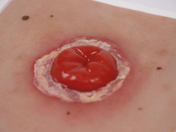 Erler Zimmer - Wundmoulage Kolostoma entzündet, inkl. Stativ