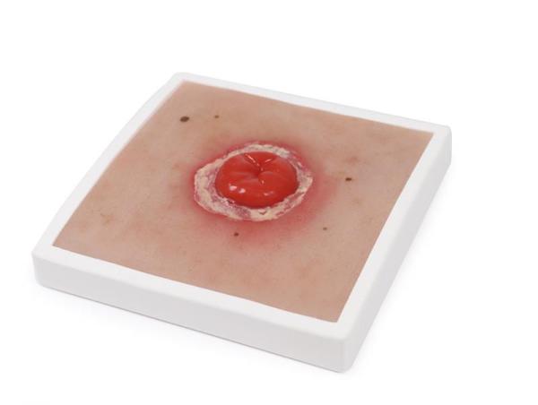 Erler Zimmer - Wundmoulage Kolostoma entzündet, inkl. Stativ