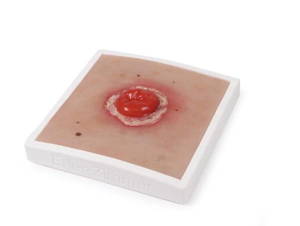 Erler Zimmer - Wundmoulage Kolostoma entzündet, inkl. Stativ